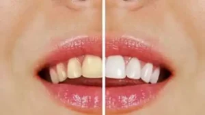 wybielanie zębów